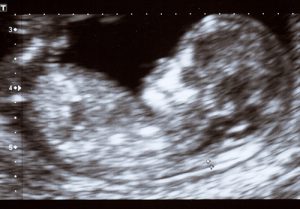 Ultrasound. Microplastics have been found in the human placenta.