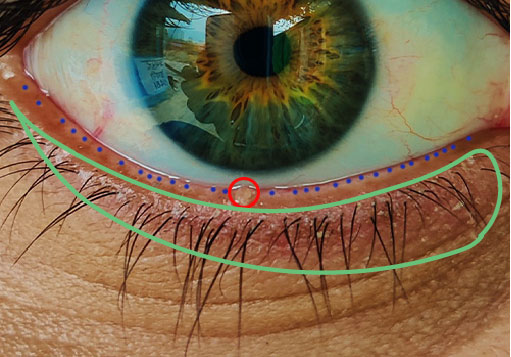 LABEL KEY: The blue dots marked above indicate the openings, or acini, that secrete oil into the eye's tear film. The red circle indicates a clogged Meibomian gland. The green indicates where the eye could be cleaned to help mitigate MGD.